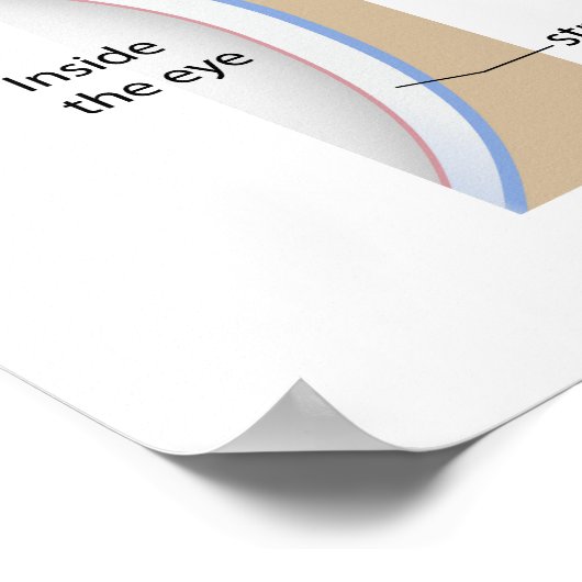 Corneal ulcer eye condition Poster ポスター (角)