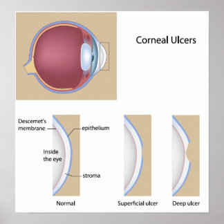 Corneal ulcer eye condition Poster ポスター