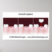 Dental implant procedure Poster ポスター (正面)