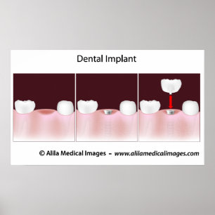 Dental implant procedure Poster ポスター