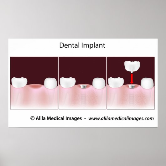 Dental implant procedure Poster ポスター (正面)