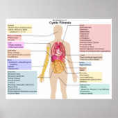 Detailed Chart of the Symptoms of Cystic Fibrosis ポスター (正面)