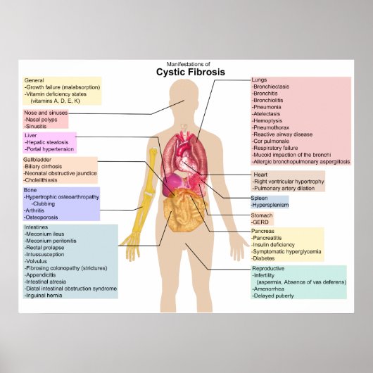 Detailed Chart of the Symptoms of Cystic Fibrosis ポスター (正面)