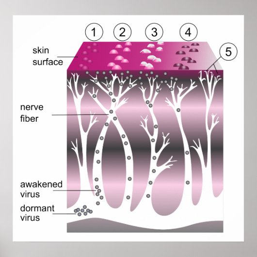 Diagram of the Progression of Shingles on Skin ポスター (正面)