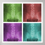 Digital X-Ray Pop Art Square Poster ポスター<br><div class="desc">Design features four different colored versions of a digitally enhanced and embellished ap lumbopelvic x-ray.</div>