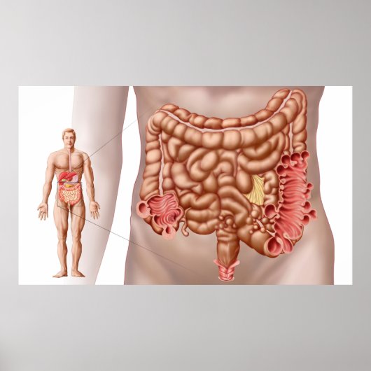 Diverticulitis In The Descending Colon Region ポスター (正面)