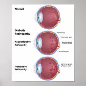 Eye disease Diabetic retinopathy Poster ポスター (正面)