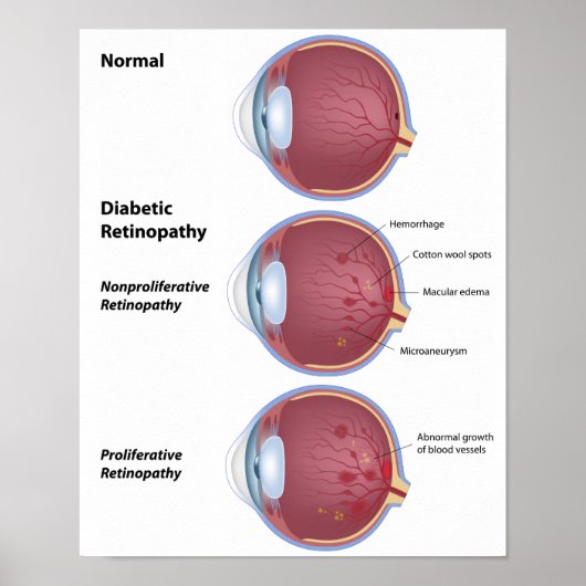 Eye disease Diabetic retinopathy Poster ポスター (正面)