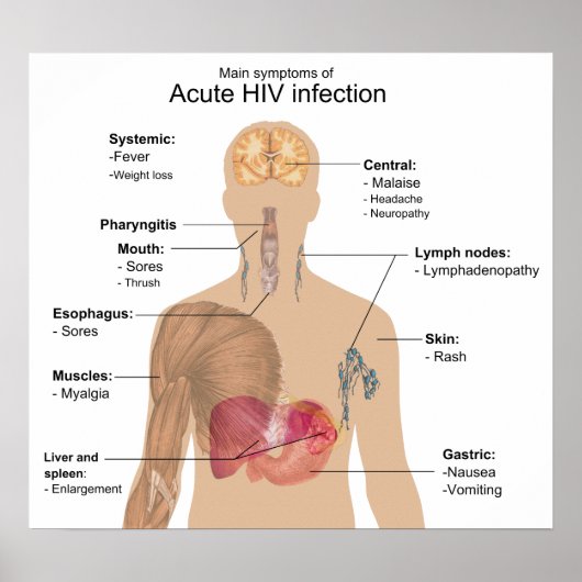 Main Symptoms of Acute HIV Infection ポスター (正面)