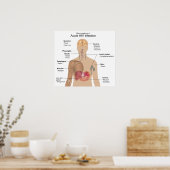 Main Symptoms of Acute HIV Infection ポスター (キッチン)