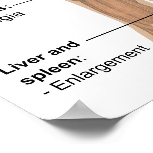 Main Symptoms of Acute HIV Infection ポスター (角)