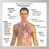 Main Symptoms of Infectious Pneumonia Diagram ポスター (正面)