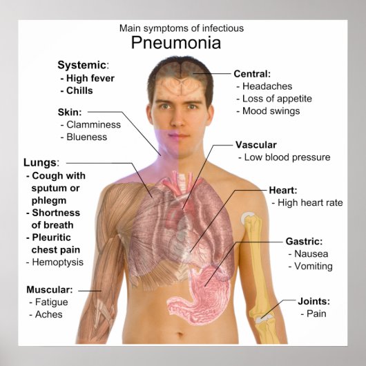 Main Symptoms of Infectious Pneumonia Diagram ポスター (正面)