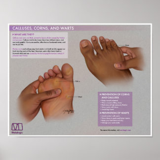 Melalogic Calluses、Corns and Warts Medical Poster ポスター