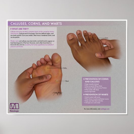 Melalogic Calluses、Corns and Warts Medical Poster ポスター (正面)