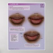 Melalogic Chapped Lips Medical Poster ポスター (正面)