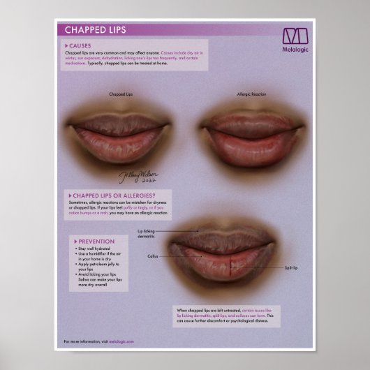 Melalogic Chapped Lips Medical Poster ポスター (正面)
