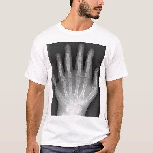 Polydactylyの6つの指手、X線、珍事! Tシャツ (正面)