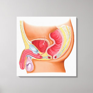 Rectourethral Fistulaの医学のイラストレーション キャンバスプリント