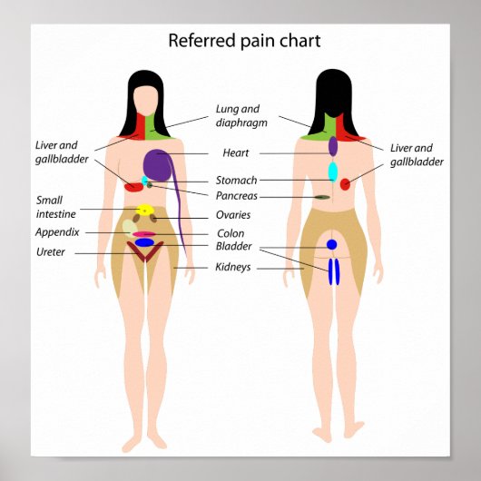 Referred pain chart Poster ポスター (正面)