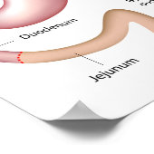 Roux-en-Y Gastric Bypass surgery poster ポスター (角)