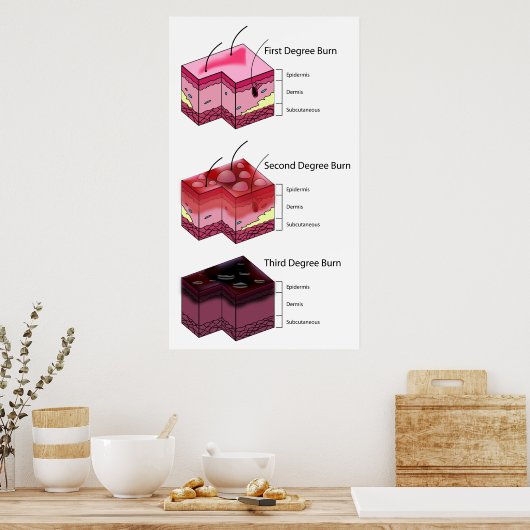 Skin Burn First Second & Third Degree Diagram ポスター (キッチン)