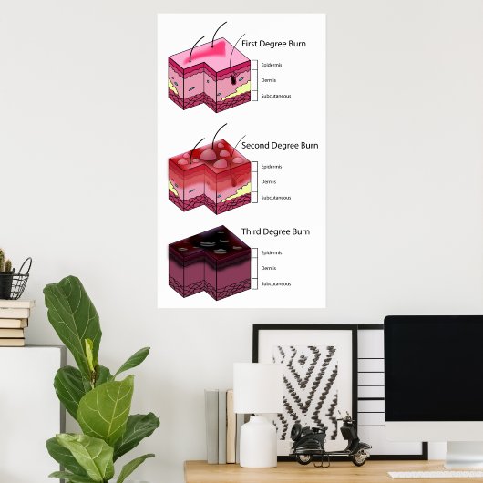 Skin Burn First Second & Third Degree Diagram ポスター (ホームオフィス)