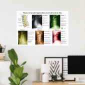 Spinal Degeneration Cervical Spine Chiropractic ポスター (ホームオフィス)