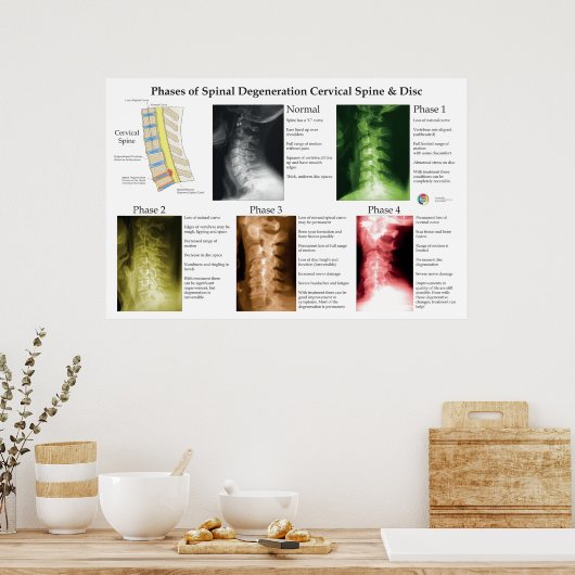 Spinal Degeneration Cervical Spine Chiropractic ポスター (キッチン)