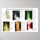 Spinal Degeneration Cervical Spine Chiropractic ポスター (正面)