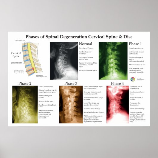 Spinal Degeneration Cervical Spine Chiropractic ポスター (正面)