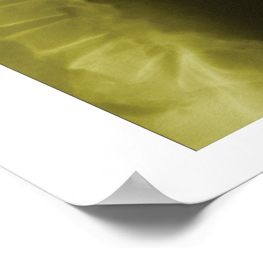 Spinal Degeneration Lumbar Spine Chiropractic ポスター (角)