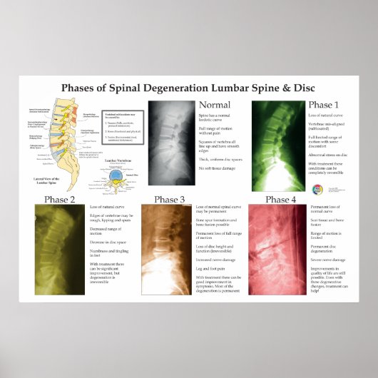 Spinal Degeneration Lumbar Spine Chiropractic ポスター (正面)