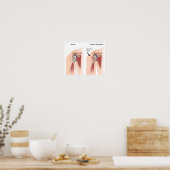 Sport injury shoulder impingement Poster ポスター (キッチン)