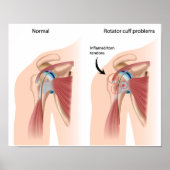 Sport injury shoulder impingement Poster ポスター (正面)