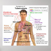 Symptom Chart of Tuberculosis in Humans ポスター (正面)