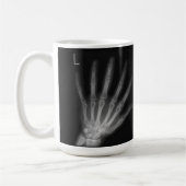 X線の右指と手離れ指数 コーヒーマグカップ (左)