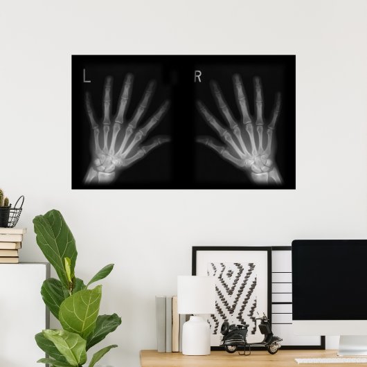 X線の右指と手離れ指数 ポスター (ホームオフィス)