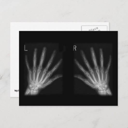 X線の右指と手離れ指数 ポストカード (正面/裏面)