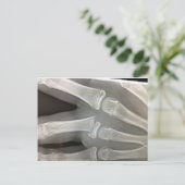 x線骨折の骨はすぐに治る ポストカード (スタンド正面)